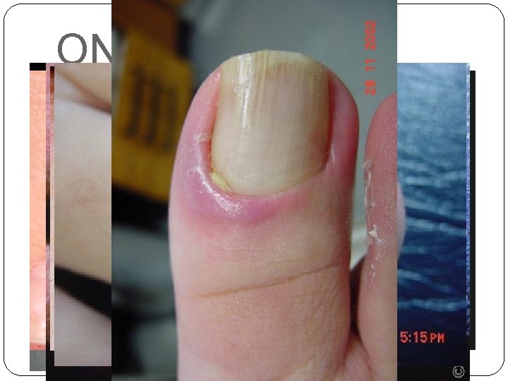 ONICOMICOSIS �Subungueal distal y lateral onicolisis e hiperqueratosis subungueal. �Subungueal proximal perionixis. �Blanca superficial