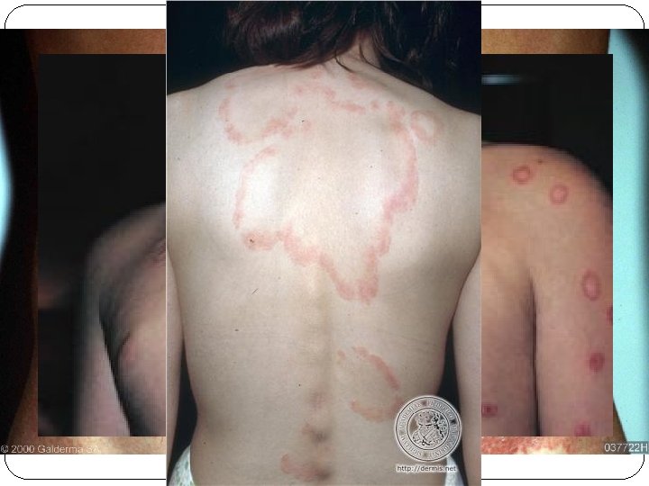 TINEA CORPORIS �Herpes circinado �Tronco y parte proximal de extremidades 