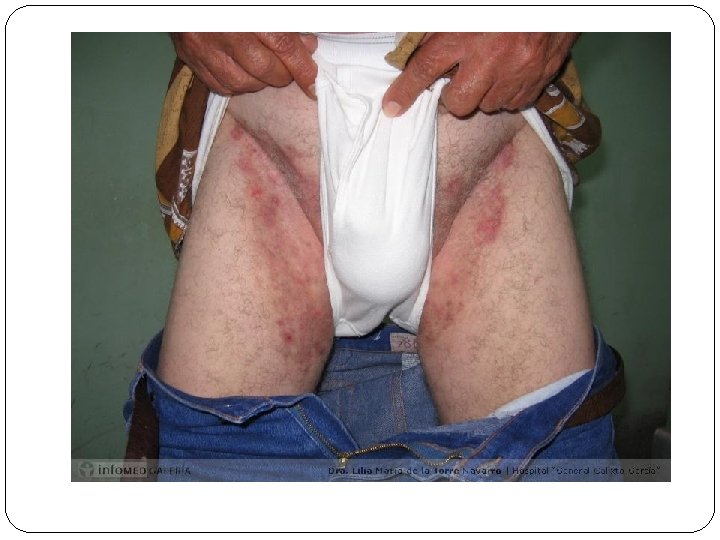 TINEA CRURIS �Eccema marginado de Hebra �Región inguinal �Más frecuente en adultos jóvenes, atletas