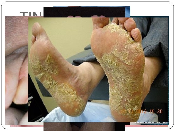 TINEA PEDIS - Eccematoso (agudo): vesiculopústulas en arco plantar. Collarete de descamación. - Interdigital