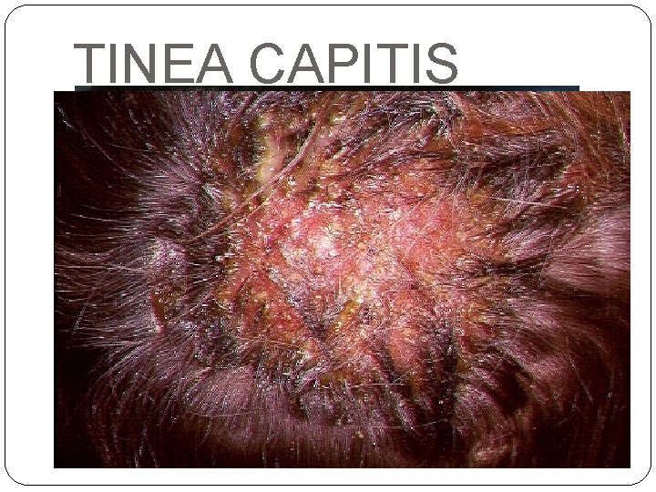 TINEA CAPITIS �Inflamatoria: placas de alopecia eritematosa con lesiones escamosas, foliculitis pustulosa y nódulos