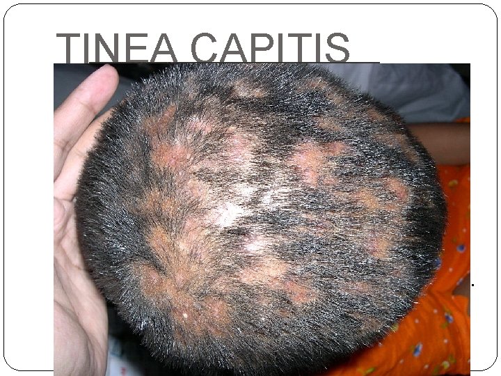 TINEA CAPITIS �Inflamatorias �No inflamatorias: - microspórica placa alopécica, base escamosa, grisácea. Cabellos cortados