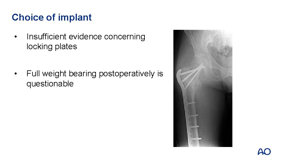 Choice of implant • Insufficient evidence concerning locking plates • Full weight bearing postoperatively