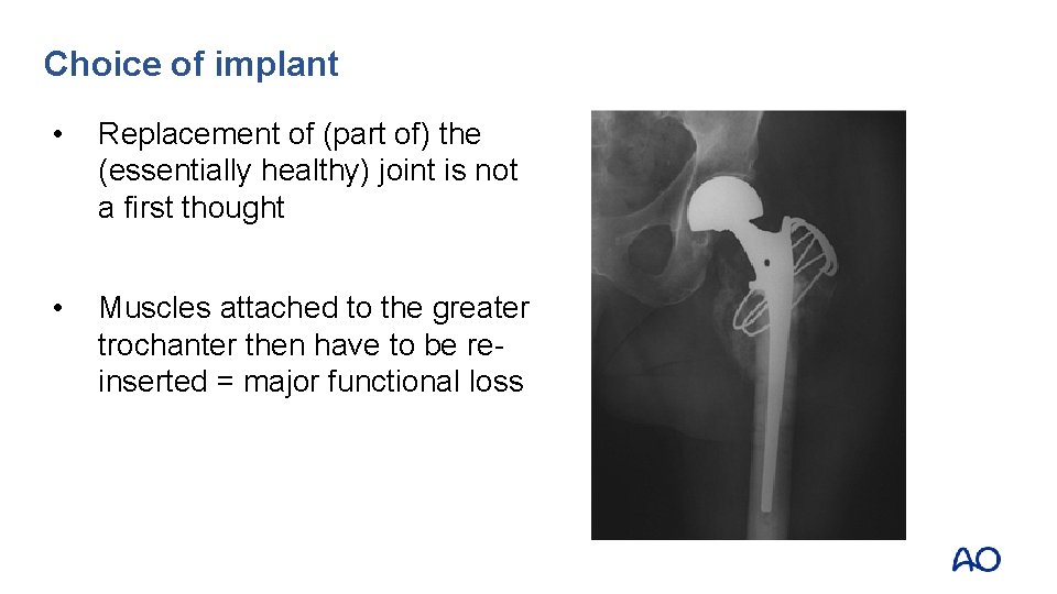 Choice of implant • Replacement of (part of) the (essentially healthy) joint is not