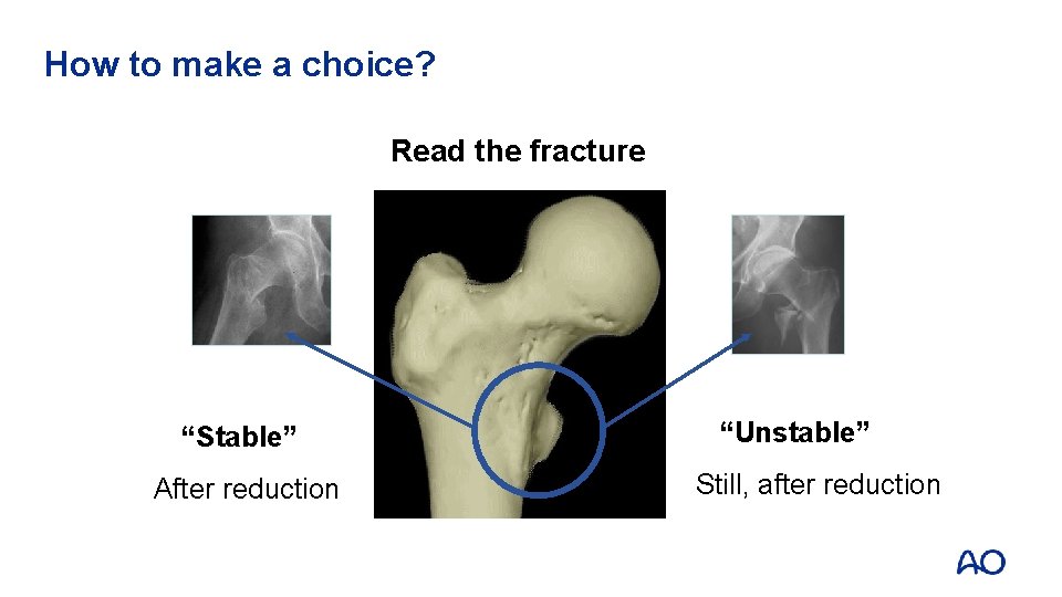 How to make a choice? Read the fracture “Stable” After reduction “Unstable” Still, after