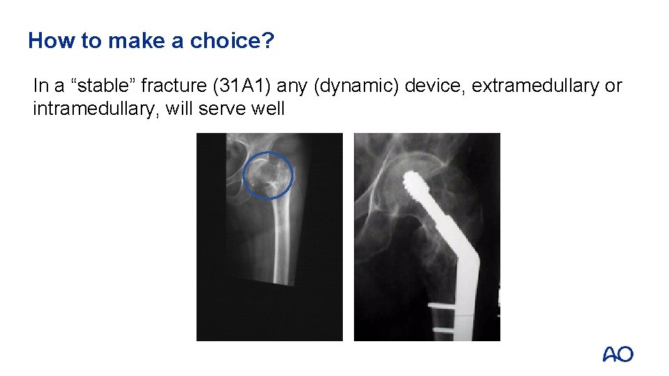 How to make a choice? In a “stable” fracture (31 A 1) any (dynamic)