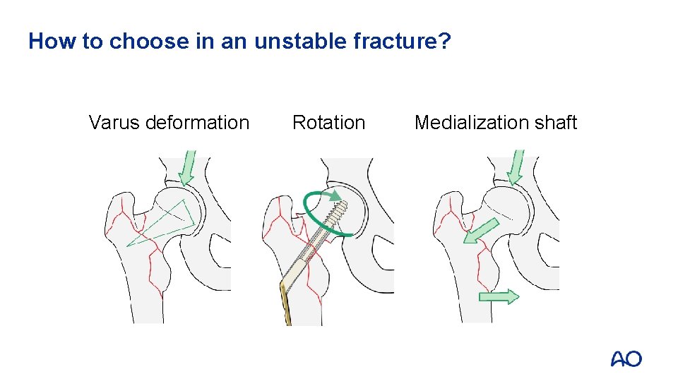 How to choose in an unstable fracture? Varus deformation Rotation Medialization shaft 