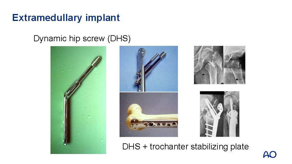Extramedullary implant Dynamic hip screw (DHS) DHS + trochanter stabilizing plate 