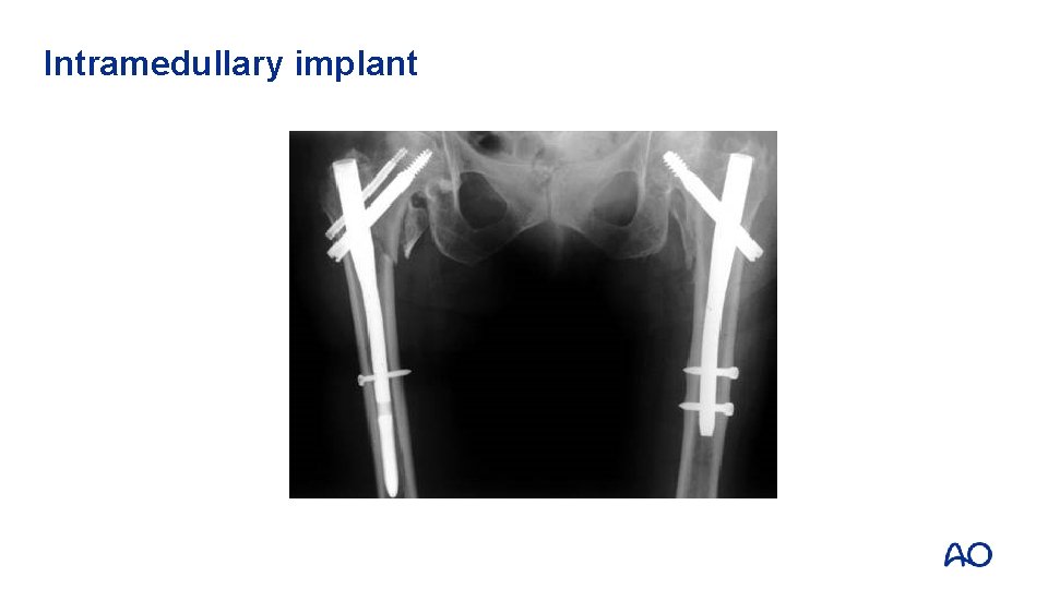 Intramedullary implant 