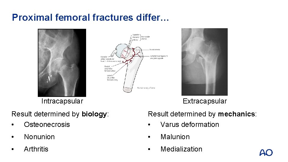 Proximal femoral fractures differ… Intracapsular Extracapsular Result determined by biology: • Osteonecrosis Result determined