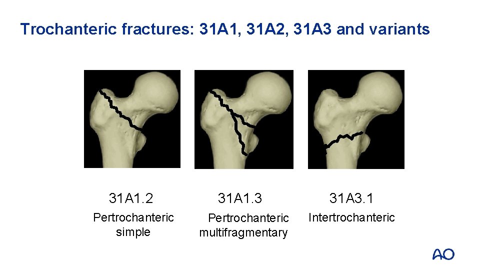 Trochanteric fractures: 31 A 1, 31 A 2, 31 A 3 and variants 31