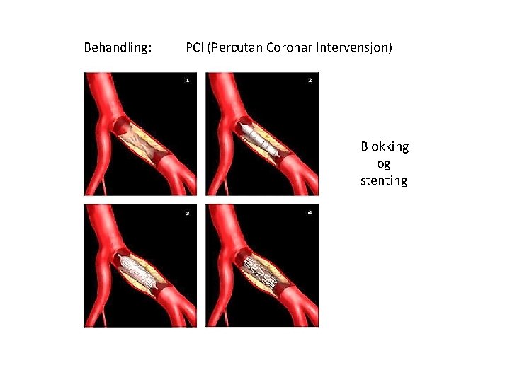 Behandling: PCI (Percutan Coronar Intervensjon) Blokking og stenting 