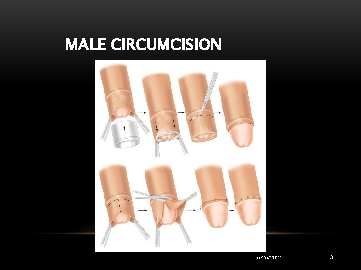 MALE CIRCUMCISION 5/25/2021 3 