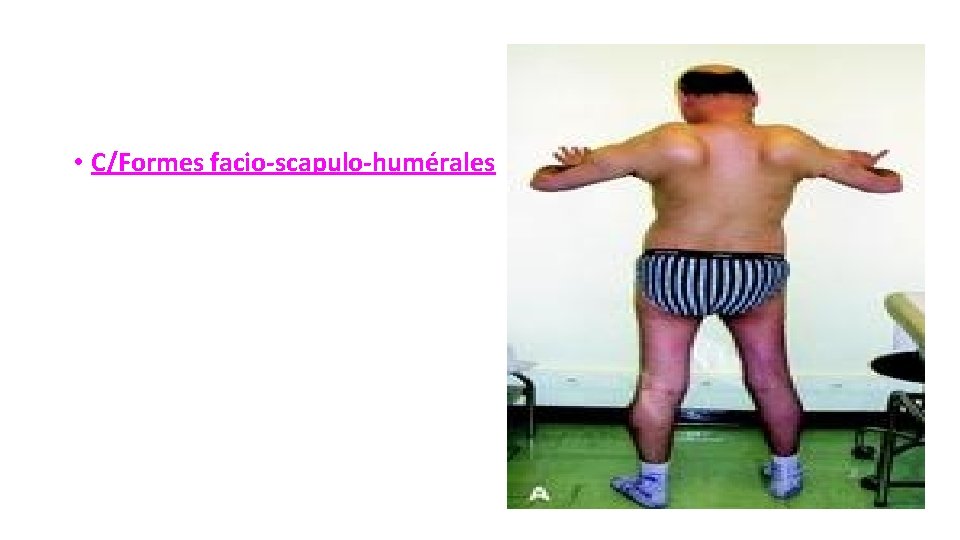  • C/Formes facio-scapulo-humérales 