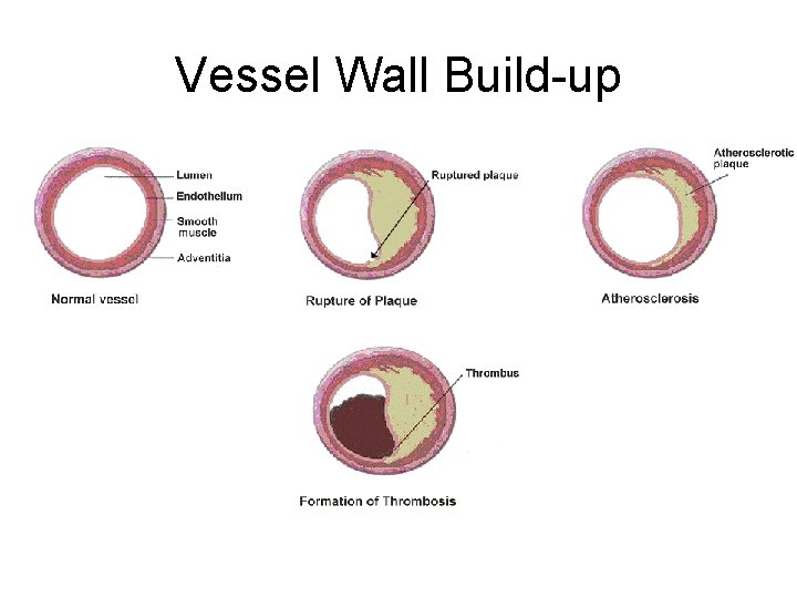 Vessel Wall Build-up 