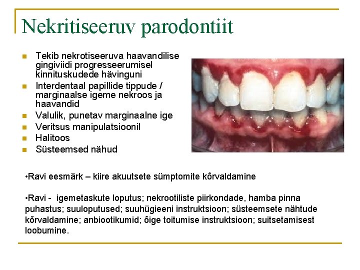 Nekritiseeruv parodontiit n n n Tekib nekrotiseeruva haavandilise gingiviidi progresseerumisel kinnituskudede hävinguni Interdentaal papillide