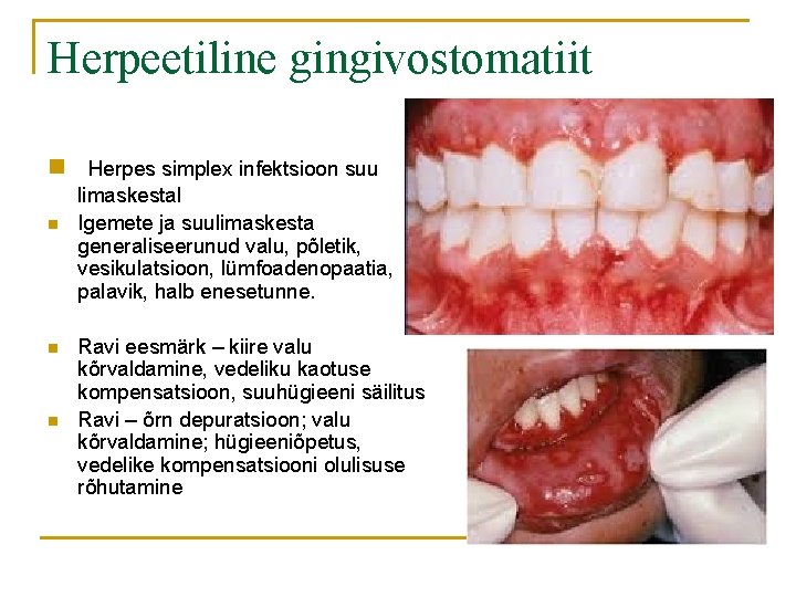Herpeetiline gingivostomatiit n Herpes simplex infektsioon suu n n n limaskestal Igemete ja suulimaskesta
