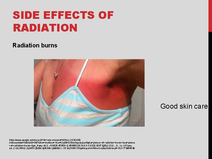 SIDE EFFECTS OF RADIATION Radiation burns Good skin care https: //www. google. com/search? rls=com.