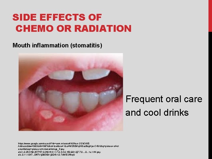 SIDE EFFECTS OF CHEMO OR RADIATION Mouth inflammation (stomatitis) Frequent oral care and cool