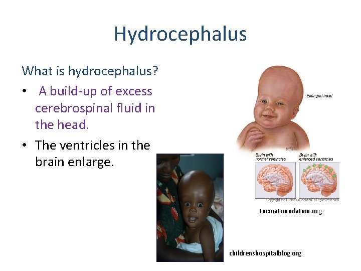 Hydrocephalus What is hydrocephalus? • A build-up of excess cerebrospinal fluid in the head.