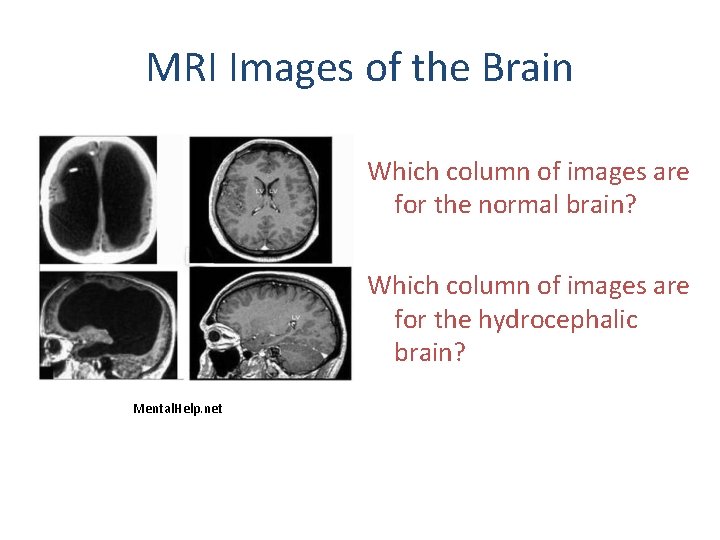 MRI Images of the Brain Which column of images are for the normal brain?