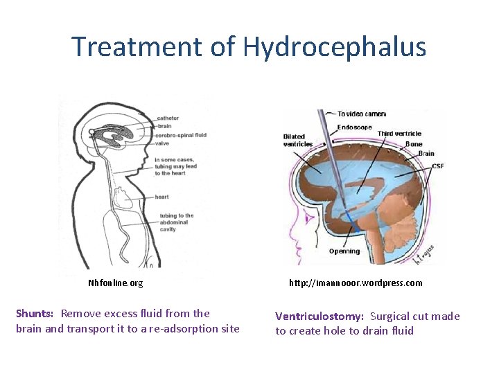 Treatment of Hydrocephalus Nhfonline. org Shunts: Remove excess fluid from the brain and transport