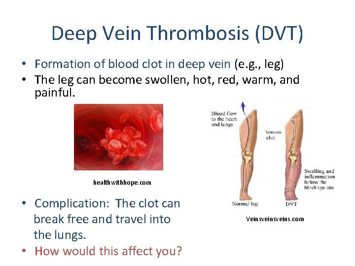 Deep Vein Thrombosis (DVT) • Formation of blood clot in deep vein (e. g.