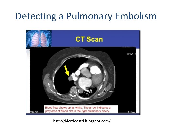 Detecting a Pulmonary Embolism http: //kierdoestri. blogspot. com/ 