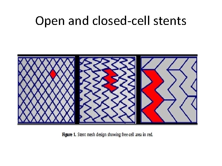 Open and closed-cell stents 
