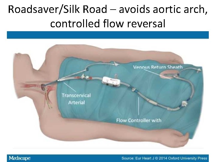 Roadsaver/Silk Road – avoids aortic arch, controlled flow reversal 