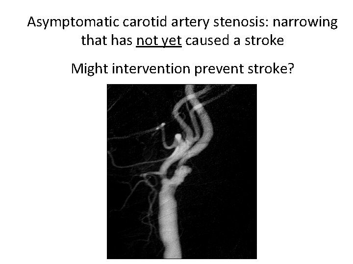 Asymptomatic carotid artery stenosis: narrowing that has not yet caused a stroke Might intervention