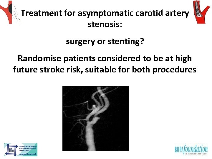 Treatment for asymptomatic carotid artery stenosis: surgery or stenting? Randomise patients considered to be