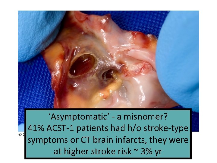 ‘Asymptomatic’ - a misnomer? 41% ACST-1 patients had h/o stroke-type symptoms or CT brain