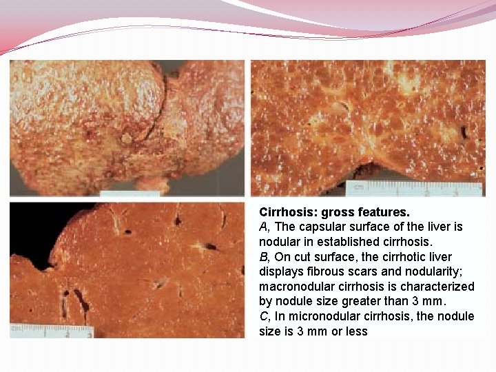 Cirrhosis: gross features. A, The capsular surface of the liver is nodular in established