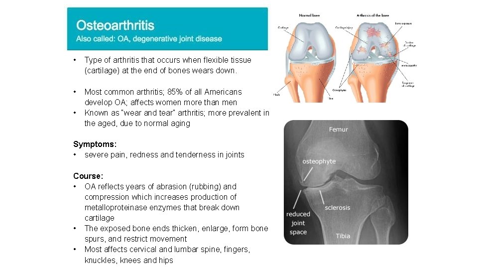  • Type of arthritis that occurs when flexible tissue (cartilage) at the end