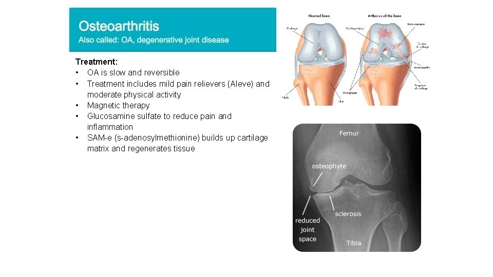 Treatment: • OA is slow and reversible • Treatment includes mild pain relievers (Aleve)