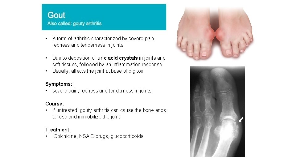  • A form of arthritis characterized by severe pain, redness and tenderness in