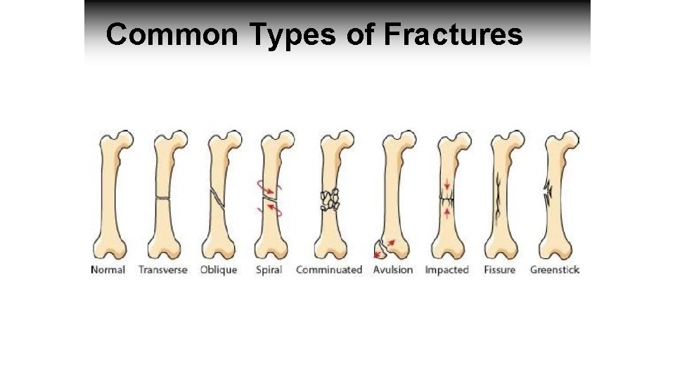 Common Types of Fractures 