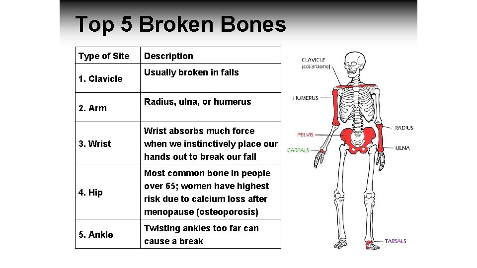 Top 5 Broken Bones Type of Site 1. Clavicle 2. Arm Description Usually broken