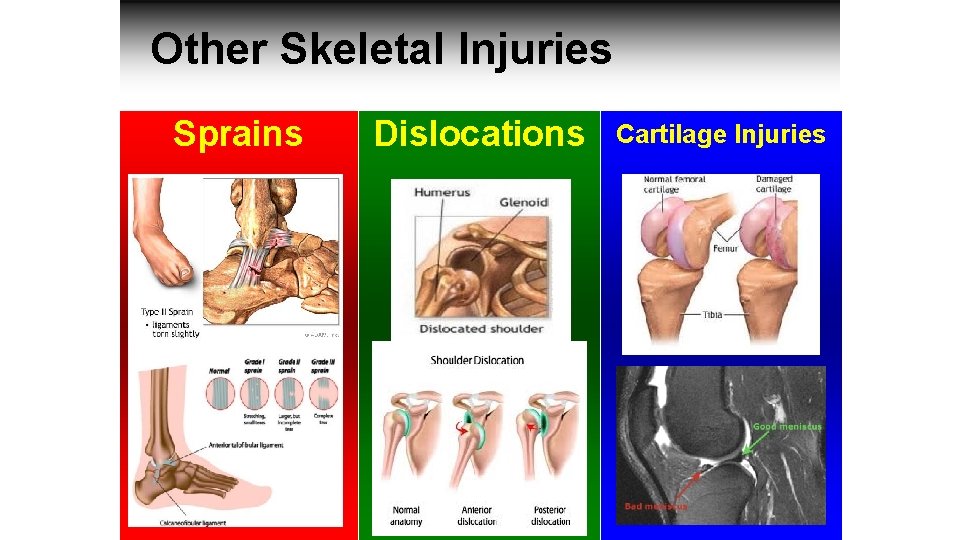 Other Skeletal Injuries Sprains Dislocations Cartilage Injuries 