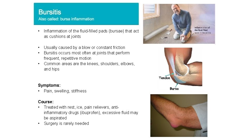  • Inflammation of the fluid-filled pads (bursae) that act as cushions at joints