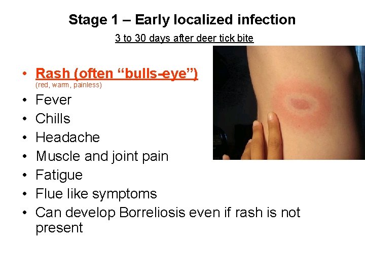 Stage 1 – Early localized infection 3 to 30 days after deer tick bite
