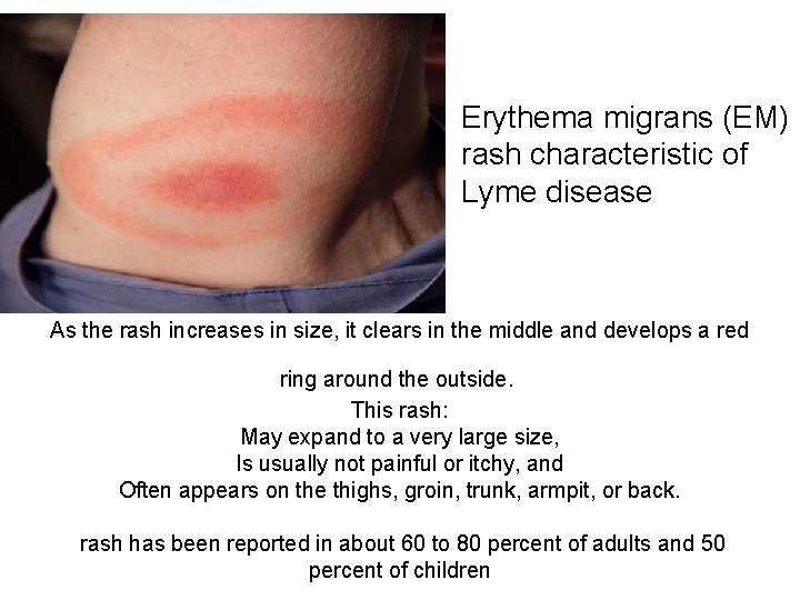 Erythema migrans (EM) rash characteristic of Lyme disease As the rash increases in size,