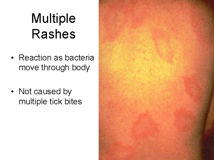 Multiple Rashes • Reaction as bacteria move through body • Not caused by multiple