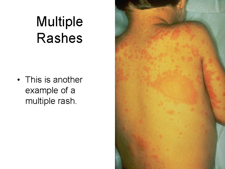 Multiple Rashes • This is another example of a multiple rash. 