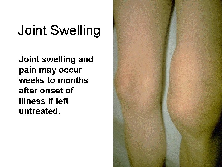 Joint Swelling Joint swelling and pain may occur weeks to months after onset of