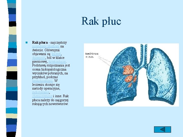 Rak płuc n Rak płuca - najczęstszy nowotwór złośliwy na świecie. Głównymi objawami są: