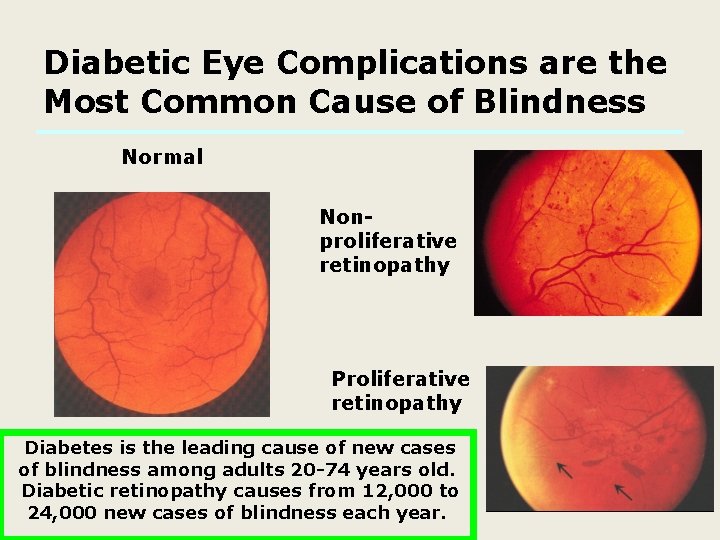 Diabetic Eye Complications are the Most Common Cause of Blindness Normal Nonproliferative retinopathy Proliferative Diabetic Eye Complications are the Most Common Cause of Blindness Normal Nonproliferative retinopathy Proliferative