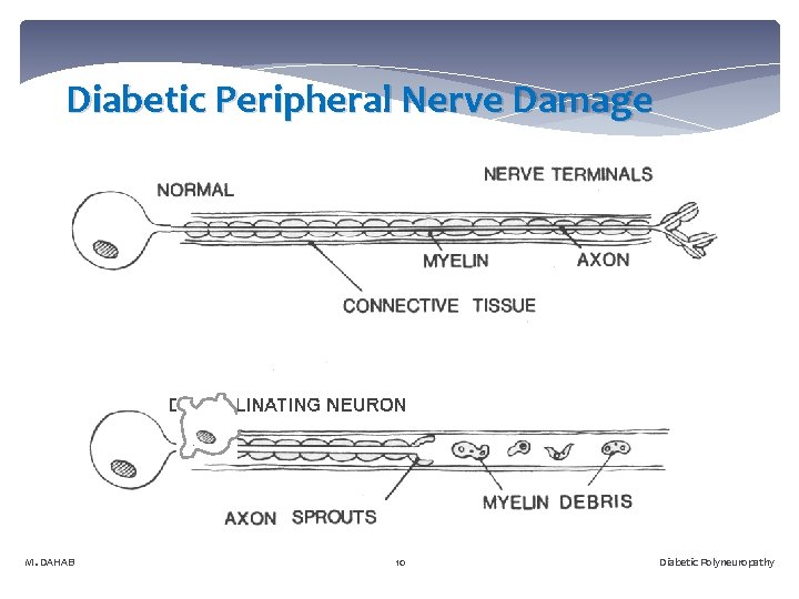 Diabetic Peripheral Nerve Damage M. DAHAB 10 Diabetic Polyneuropathy 