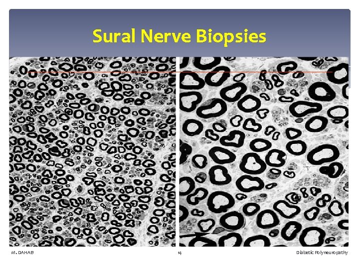 Sural Nerve Biopsies M. DAHAB 14 Diabetic Polyneuropathy 